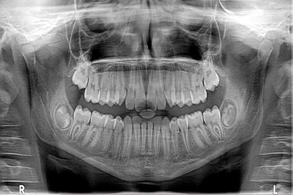 how much is a dental xray